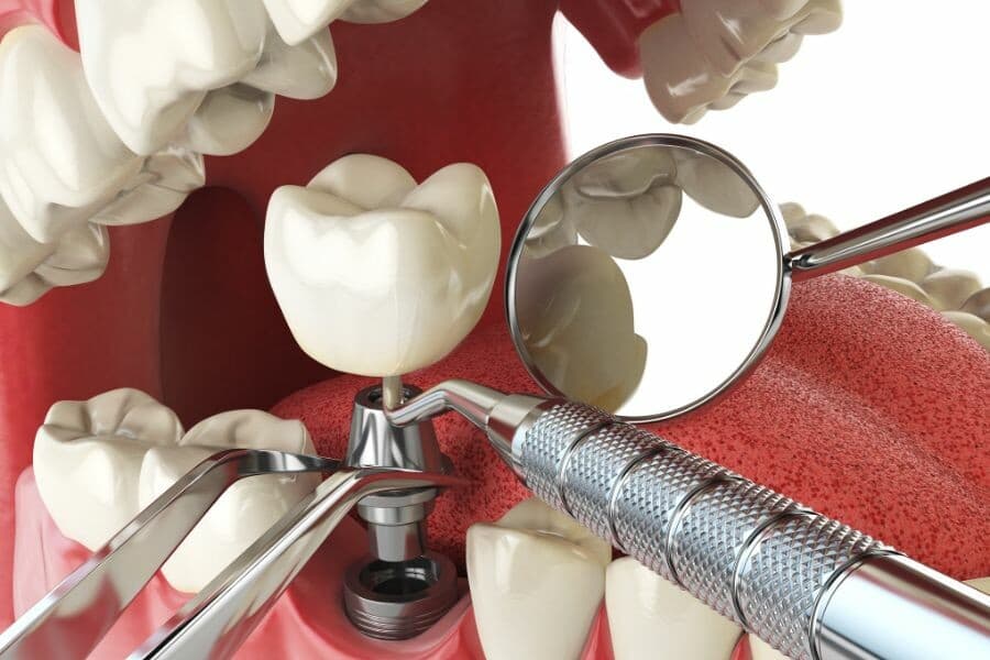 Dental Implants at Lehman & Menis