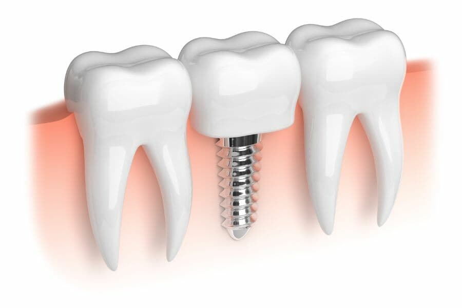 Dental Implants in Crystal Lake