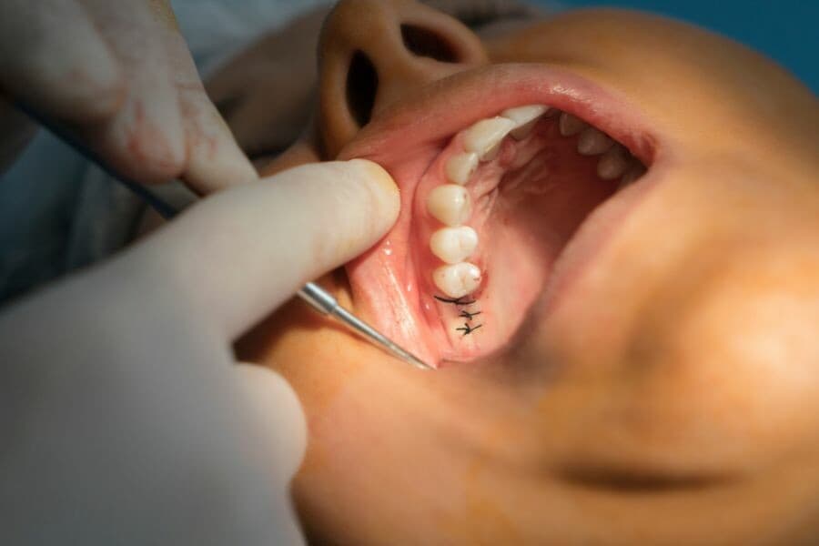 How-Soon-Can-You-Eat-After-Getting-Dental-Implants-Image-1.jpg