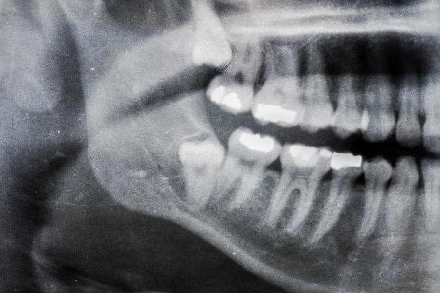 What-Does-It-Mean-If-My-Wisdom-Teeth-Are-Impacted-Image-2.jpg