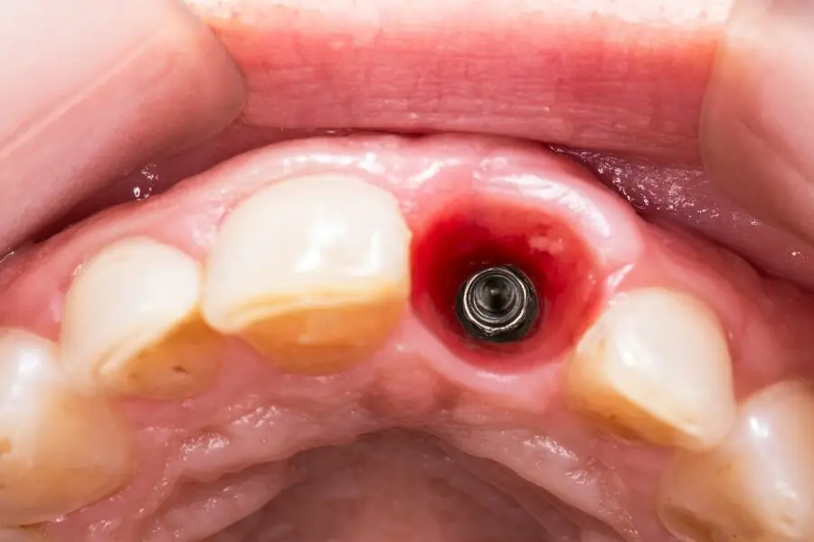 What-is-a-Dental-Implant-Image-1.webp