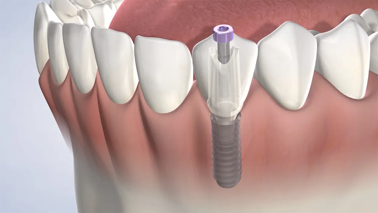Procedure hero desktop dental implant