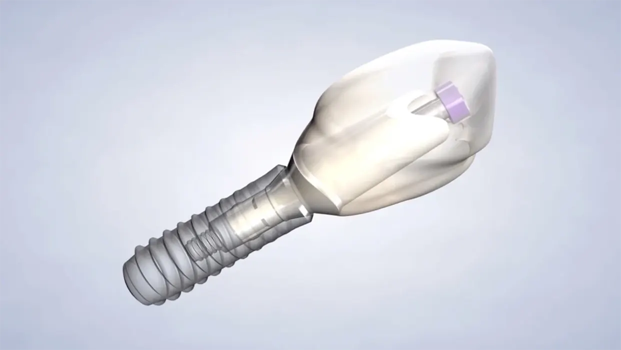Illustration of a dental implant