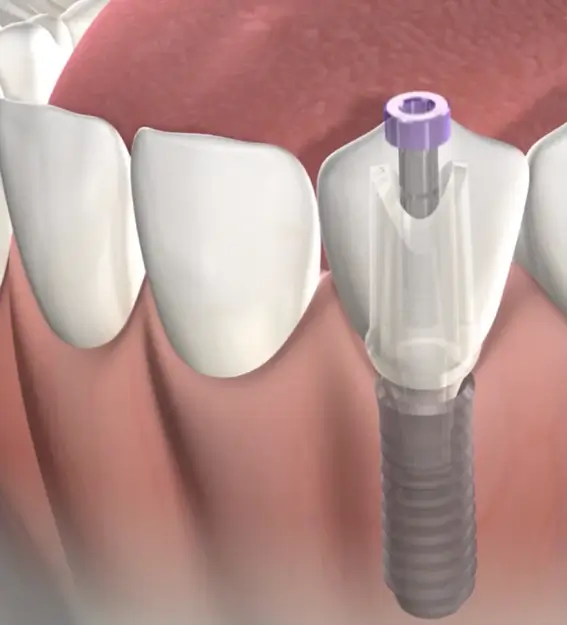 Procedure featured dental implant
