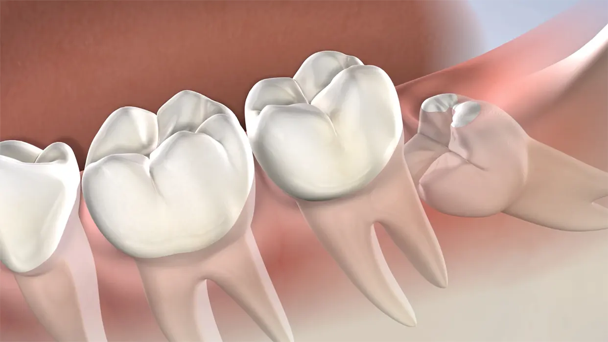 Illustration of an impacted wisdom tooth