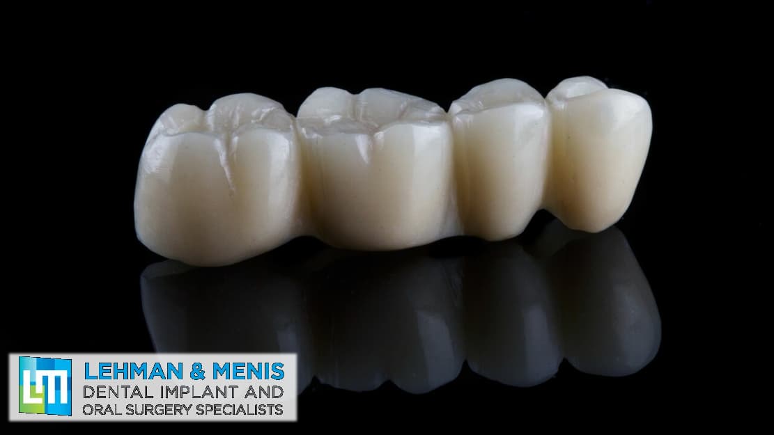 What's the Difference Between Dental Implants and Bridges?