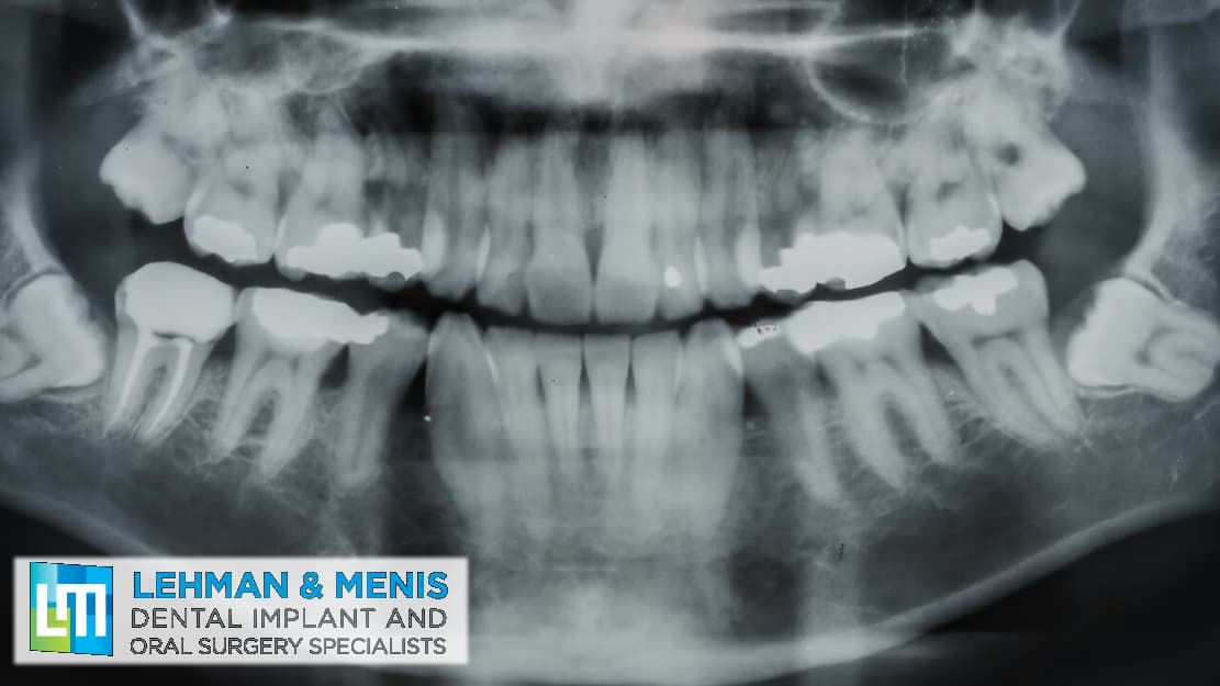 What Does It Mean If My Wisdom Teeth Are Impacted?